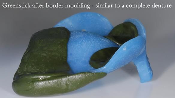 Finlay's Newsletter 58 Gasket upper partial denture for Zoe