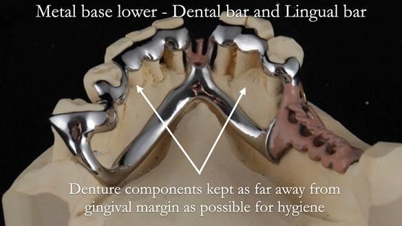 Newsletter 54 case presentation upper complete denture and lower Scandinavian designed hygienic partial denture for David