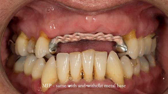 Finlay's Newsletter 63 Case study provision of metal based Scandinavian RPD - functional 10 years on
