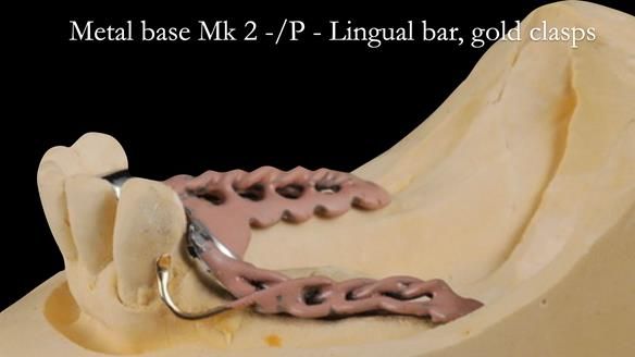 Newsletter 52 Managing Jo’s failing dentition with extractions and Mk 1/Mk 2 complete upper dentures and lower partial dentures FULL PROTOCOL