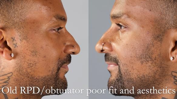 Acrylic based partial denture/obturator had poor, retention and support Obturator section was in poor condition. The Adams clasp were causing inflammation of the gingival margins. The clasp on the UR3 was visible resulting in poor appearance. Reduced lip