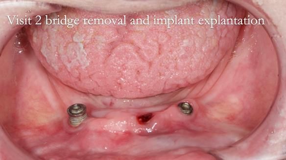 Newsletter 49 Managing Estelle’s failing implants with dentures FULL PROTOCOL