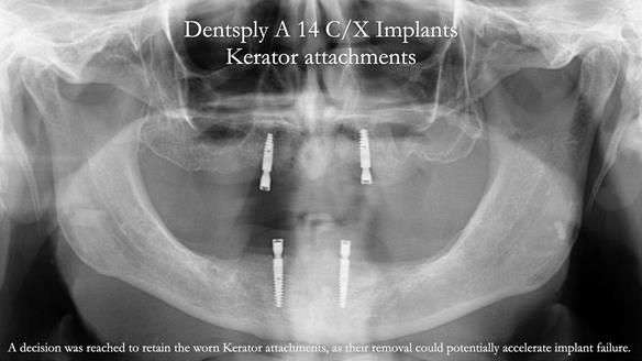 Newsletter 57 showcases the making and fitting process of implant-supported complete dentures for Alisdair