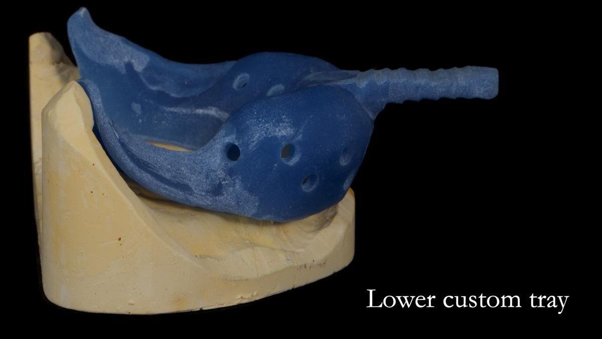 Newsletter 87 – Father Peter: A Partial Denture that needed Minor Miracle