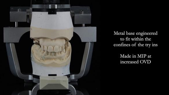 Finlay's Newsletter 60 Sylvia's upper Kennedy Class 2 Mod 1 metal based upper RPD