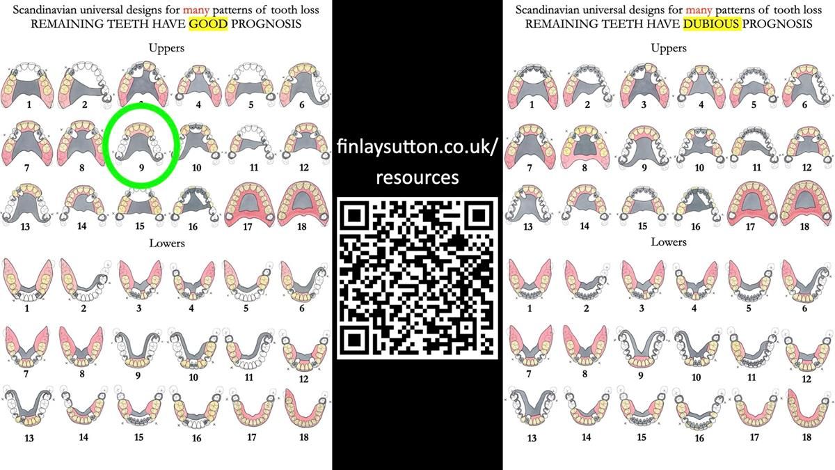 Newsletter 89 – Simon: A Challenging Kennedy Class II Division 1 Upper CoCr Partial Denture with a High Smile Line