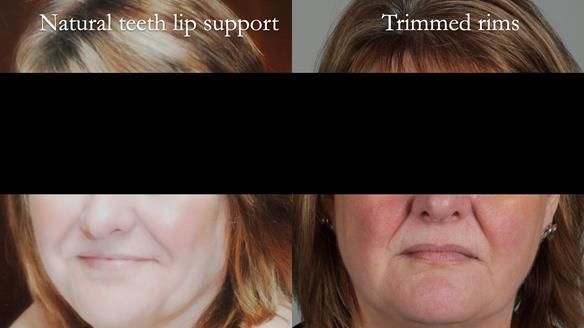 Finlay's Newsletter 58 Gasket upper partial denture for Zoe