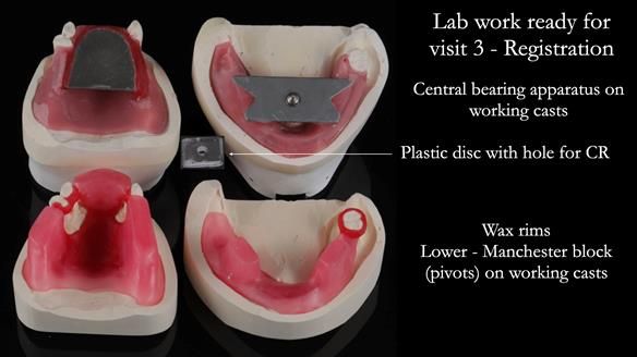 Finlay's Newsletter 59 Ultra hard partial dentures made for Gill