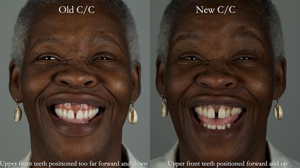 Newsletter 53 showing the making and fitting of ultra life-like dentures for Valena