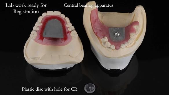 Newsletter 54 case presentation upper complete denture and lower Scandinavian designed hygienic partial denture for David