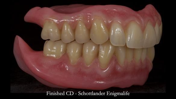 Newsletter 83: Sheila’s Complete Denture Success