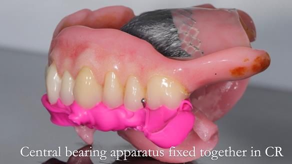 Newsletter 54 case presentation upper complete denture and lower Scandinavian designed hygienic partial denture for David