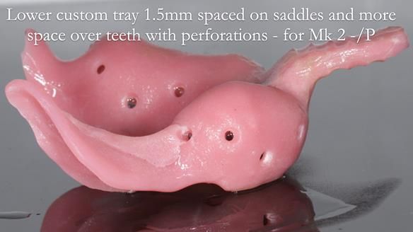 Newsletter 54 case presentation upper complete denture and lower Scandinavian designed hygienic partial denture for David