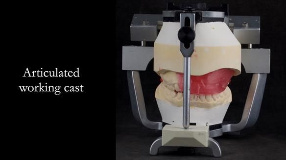 Upper metal base partial denture/occlusal stabilisation splint/obturator - full protocol