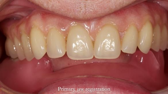 Newsletter 82 Mary - A complete upper and a one-tooth gasket denture