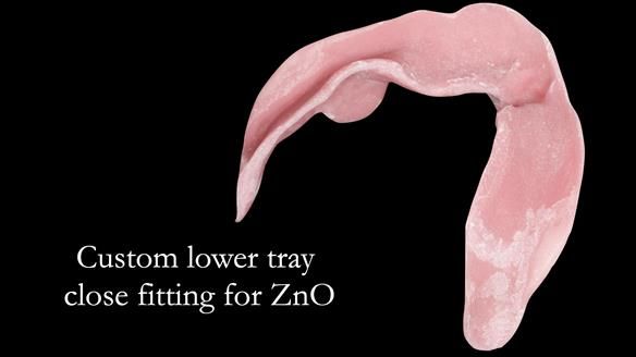 Managing poor implant positioning with complete dentures and Locator attachments - full protocol Newsletter 41