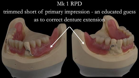Finlay's Case Study Newsletter 40 - Immediate Mk 1 RPD to Definitive Mk 2 RPD - full protocol