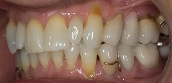 Figure 84 Definitive dentures fitted.