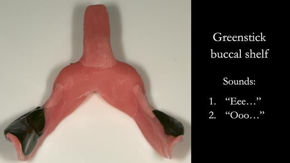 Greenstick right and left buccal shelves from canine to second molar position – avoid the retromolar pad – this is moulded in the patients mouth by the patient saying “EEE” and “OOO” with exaggerated cheek movements.