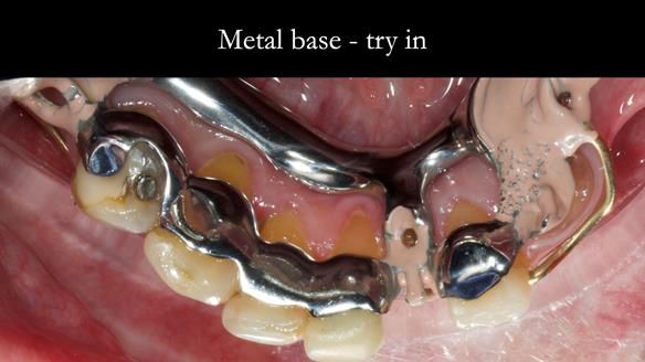 Newsletter 55 Provision of metal based partial dentures for Zephyrine with a repaired cleft lip and palate