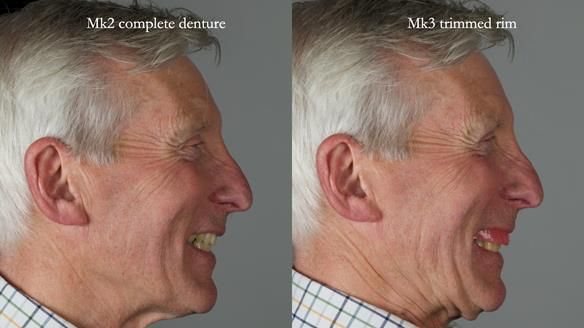 Newsletter 77: Jeremy’s case – immediate complete upper denture