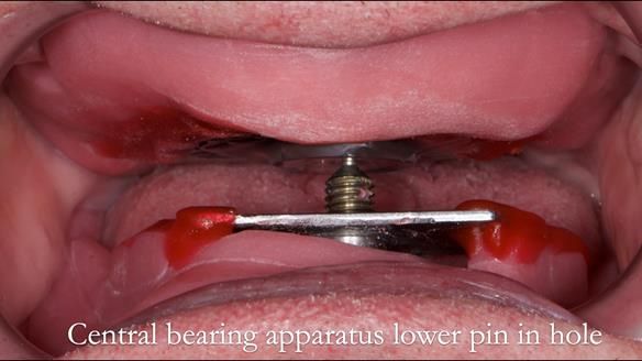 Complete denture Class II div 2 deep overbite Newsletter 39