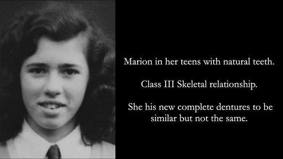 Newsletter 75: Marion’s case - Step-by-step complete denture workflow