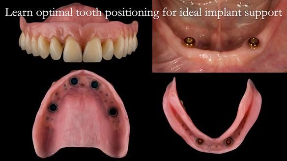Finlay's Newsletter 58 Gasket upper partial denture for Zoe