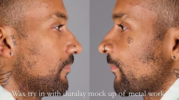 Upper metal base partial denture/occlusal stabilisation splint/obturator - full protocol