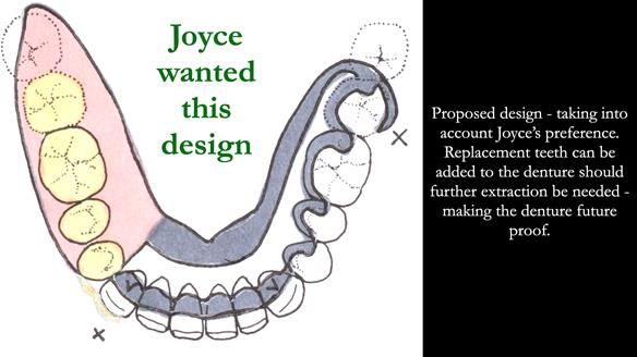 Finlay's Newsletter 61 provision of a lower unilateral free end saddle metal based partial denture for Joyce