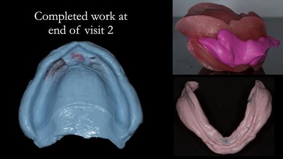 Newsletter 75: Marion’s case - Step-by-step complete denture workflow