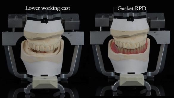 Newsletter 82 Mary - A complete upper and a one-tooth gasket denture