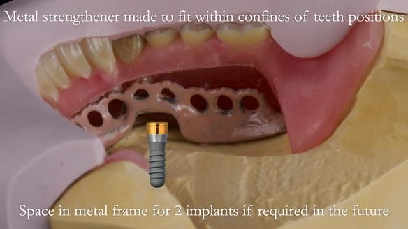 Newsletter 50 Special edition Complete Dentures FULL PROTOCOL