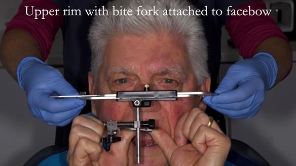 Finlay's Newsletter 64 case study - provision of a Kennedy class 2 metal based Scandinavian RPD for Ian