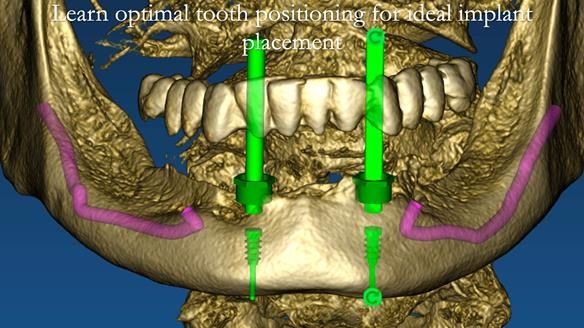 Finlay's Newsletter 58 Gasket upper partial denture for Zoe