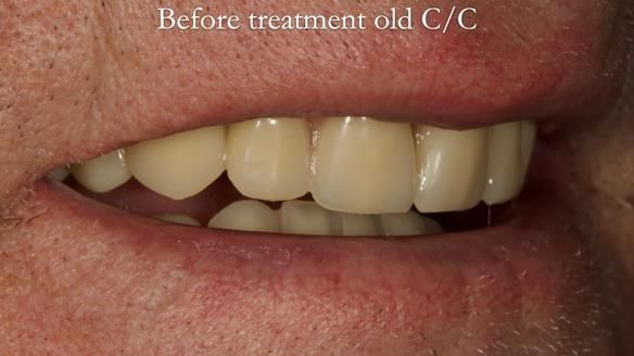 Complete denture Class II div 2 deep overbite Newsletter 39