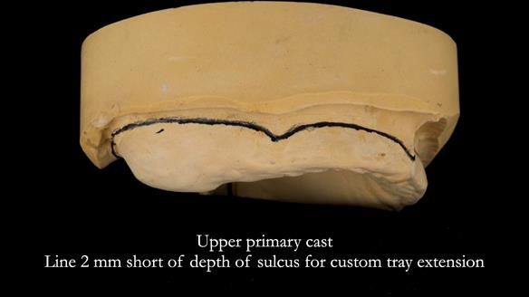Complete denture Class II div 2 deep overbite Newsletter 39