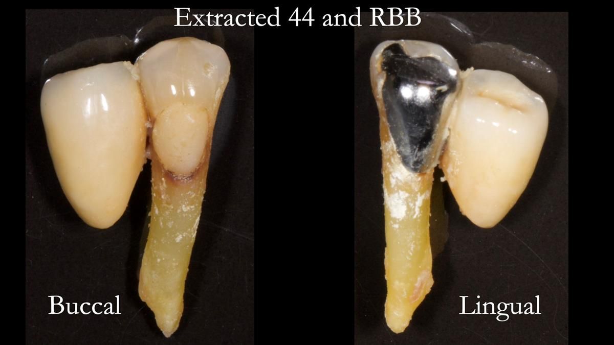 Newsletter 87 – Father Peter: A Partial Denture that needed Minor Miracle