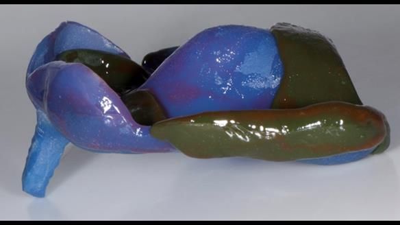 Newsletter 77: Jeremy’s case – immediate complete upper denture