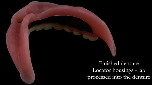 Finished metal reinforced implant supported over denture - notice shape of the denture