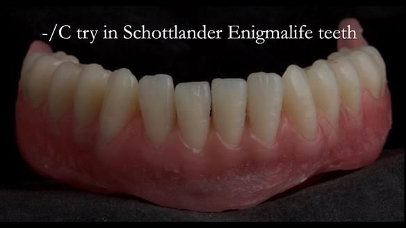 Managing poor implant positioning with complete dentures and Locator attachments - full protocol Newsletter 41
