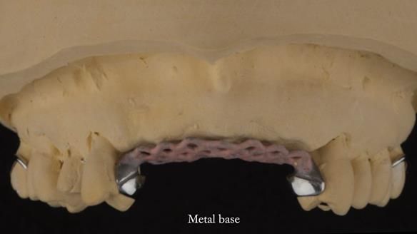 Finlay's Newsletter 63 Case study provision of metal based Scandinavian RPD - functional 10 years on