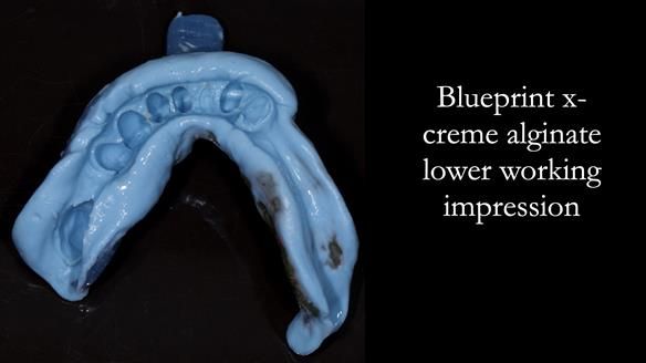 Newsletter 55 Provision of metal based partial dentures for Zephyrine with a repaired cleft lip and palate