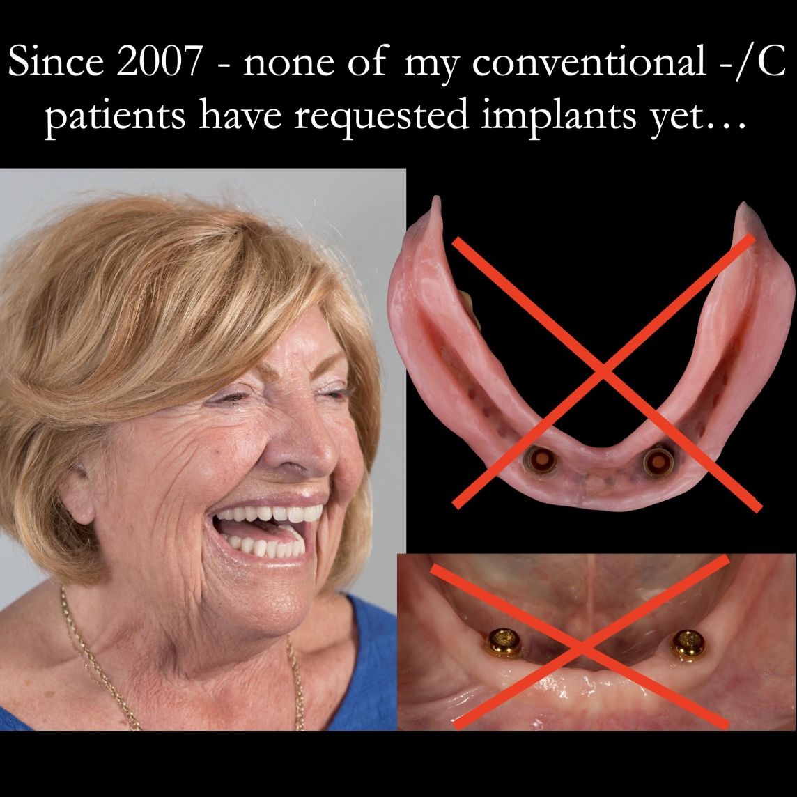 Do my complete denture patients need implants?