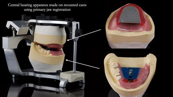 Newsletter 82 Mary - A complete upper and a one-tooth gasket denture
