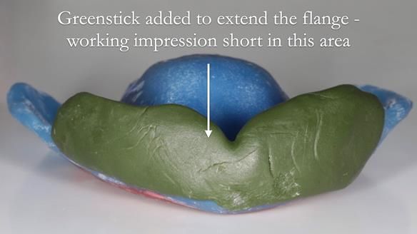 Newsletter 53 showing the making and fitting of ultra life-like dentures for Valena