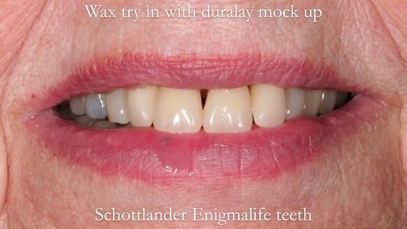 Finlay's Newsletter 59 Ultra hard partial dentures made for Gill