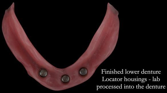 As the patient was travelling from Ireland I decided to have the housings processed into the denture. This ensures a better finish where the housings fit into the denture. The downside of this is that the tissue fit on the soft tissues is not quite as goo