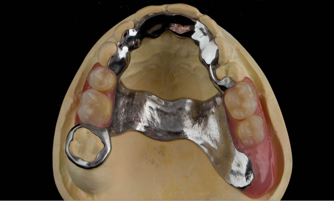 Management of a patient with toothwear and bruxism using additive composite restorations and a metal based RPD/splint