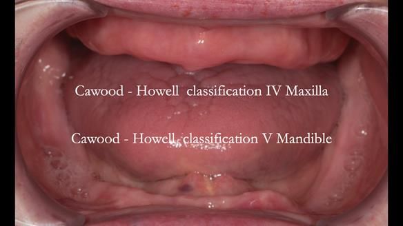 Newsletter 75: Marion’s case - Step-by-step complete denture workflow